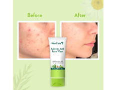 WishCare 2% Salicylic Acid Face Wash for Women & Men with AHA, GreenTea, Chamomile & TeaTree - Face Wash for Oily Skin & Acne Prone Skin 100ml