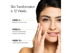 Kapiva Acne Ease Fizz | 100% Ayurvedic Acne Control Fizz Tablet | Clear, Pimple-Free Skin | Blood Purifier with Neem, Tulsi, Sandalwood | Orange Flavor