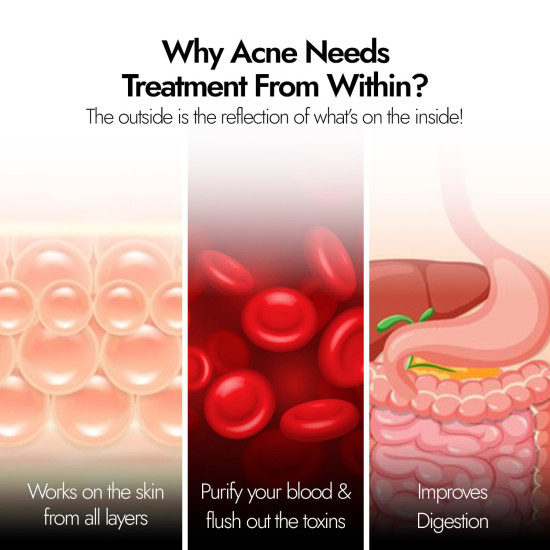 Kapiva Acne Ease Fizz | 100% Ayurvedic Acne Control Fizz Tablet | Clear, Pimple-Free Skin | Blood Purifier with Neem, Tulsi, Sandalwood | Orange Flavor Kapiva Acne Ease Fizz | 100% Ayurvedic Acne Control Fizz Tablet | Clear, Pimple-Free Skin | Blood Purifier with Neem, Tulsi, Sandalwood | Orange Flavor