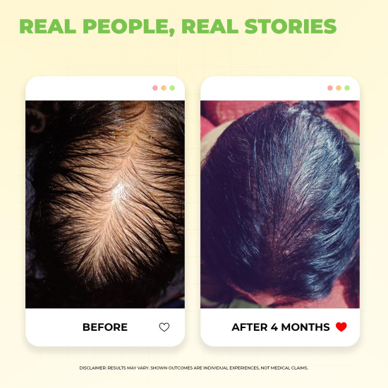 Avimee Herbal Scalptone Hair Growth Serum | Scientifically Proven Formula | Enriched with Nansyl & Green Tea Extract | For Hair Growth & Hair Fall Reduction | 25 ml