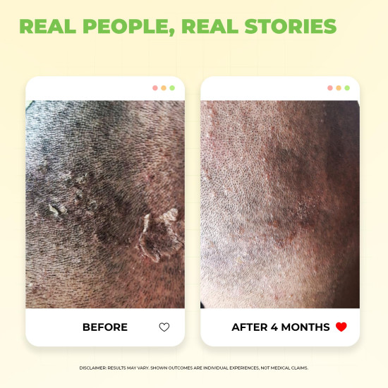 Avimee Herbal Scalptone Dandruff Serum | Anti dandruff hair serum | Helps with Dandruff and Nourishes Scalp | For Men & Women | 25 ml