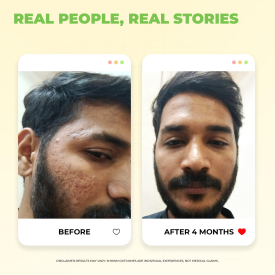 Avimee Herbal 10% Vitamin C Serum for Glowing Skin | Enriched with Hyaluronic Acid | Non Irritating, Safe for Sensitive Skin | Non Sticky | Clinically Proven Formula | For Men and Women| 25 mL Avimee Herbal 10% Vitamin C Serum for Glowing Skin | Enriched with Hyaluronic Acid | Non Irritating, Safe for Sensitive Skin | Non Sticky | Clinically Proven Formula | For Men and Women| 25 mL