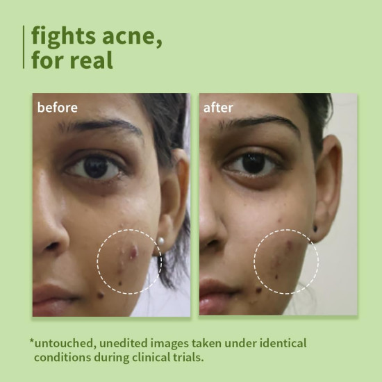 Plum Green Tea Pore Cleansing Face Wash for Oily, Acne Prone, Dry & Combination Skin | with Glycolic Acid | Fight Pimples & Control Excess Oil | Gentle Exfoliating & Non-Drying | Women & Men | 150ml