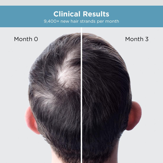 The Man Company Hair Growth Serum for Man (30ml) with 3% Redensyl, 4% Anagain, 3% Biacapil | Stimulates Hair Growth | Prevents Hair Fall | Improves Hair Strength The Man Company Hair Growth Serum for Man (30ml) with 3% Redensyl, 4% Anagain, 3% Biacapil | Stimulates Hair Growth | Prevents Hair Fall | Improves Hair Strength