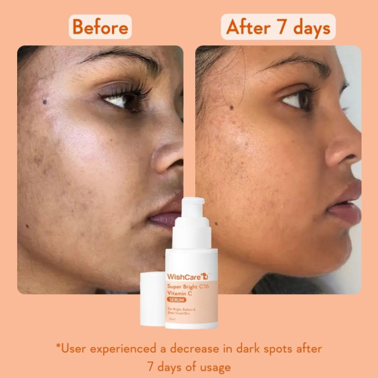 WishCare Super Bright C16 Vitamin C Serum For Oily Skin,Dry & Combination Skin -10% Vitamin C,4% Niacinamide,1% Kojic Acid,0.5% Ferulic Acid,Licorice & 4-N-BR- Serum For Pigmentation & Dark Spots 30Ml